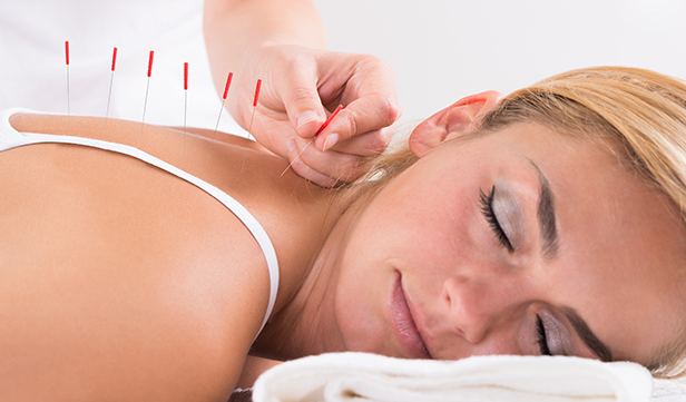 Woman relaxes as she receives acupuncture treatment